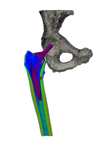 Implant design and population based fit studies to inform engineering