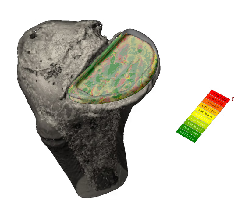 Pre-op and Post-op medical image driven Principal Density Analysis for surgical outcomes scoring